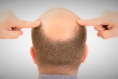 La caída del cabello en hombres: 5 claves para frenar la alopecia y recuperar tu confianza