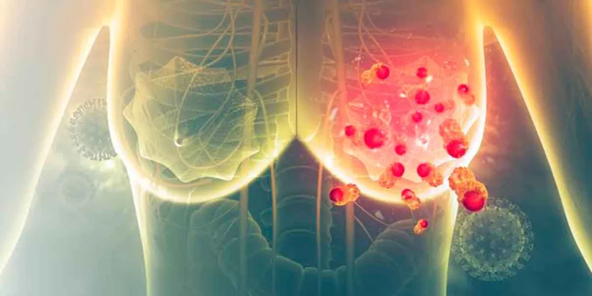 Cáncer de mama: 80% de los casos ocurre sin riesgos específicos, dice OMS